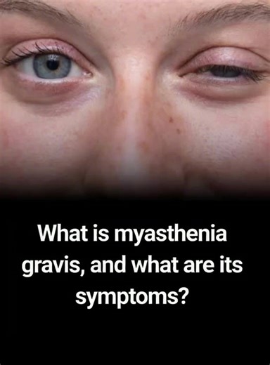 26K views · 15 reactions | Among autoimmune dise:ases, myasthenia gravis is known for causing muscle weakness and fatigue. So, what exactly is myasthenia gravis, and what symptoms should you look out for? You’ll find all the details about this condition in our article. | Feedy | Facebook