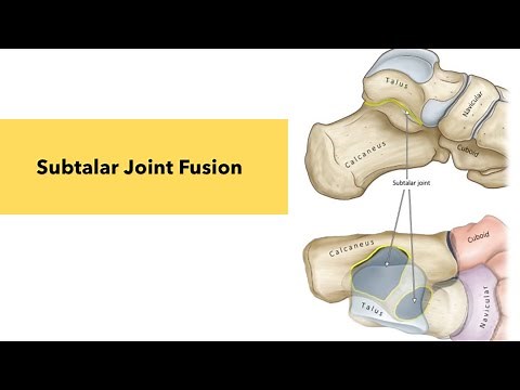 Subtalar joint fusion