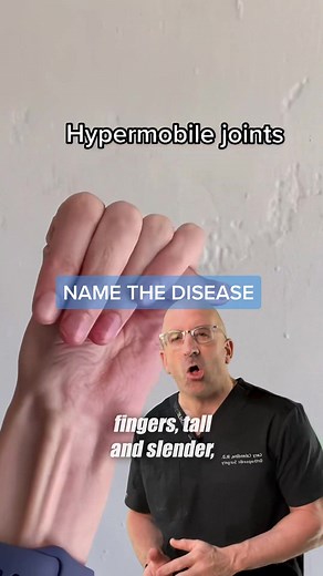 Recognize the condition⁉️ Marfan syndrome - inherited connective tissue disorder that most commonly affects the heart, eyes, blood vessels and skeleton. Marfan syndrome patients are usually tall/thin with unusually long arms, legs, fingers and toes and hypermobile joints. If the #connectivetissue of the aorta (the large blood vessel that carries blood from your heart to the rest of your body is affected), the condition can become life-threatening ##marfansyndrome #geneticdisorder #hypermobility 