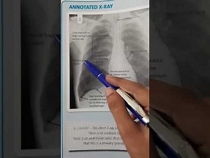 Chest Xray interpretation of Pneumothorax Case