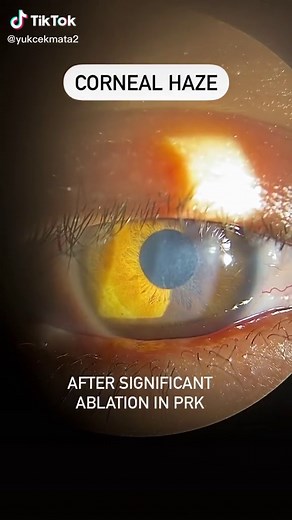 Understanding Corneal Haze: Causes and Treatment