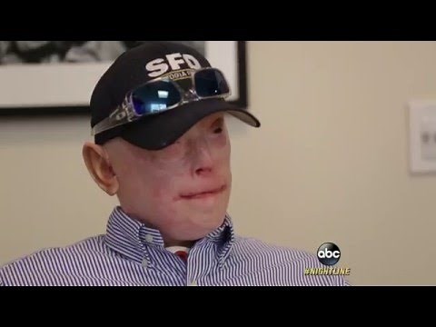 Severely-Burned Former Firefighter Opts for Face Transplant: Part 1 | ABC News
