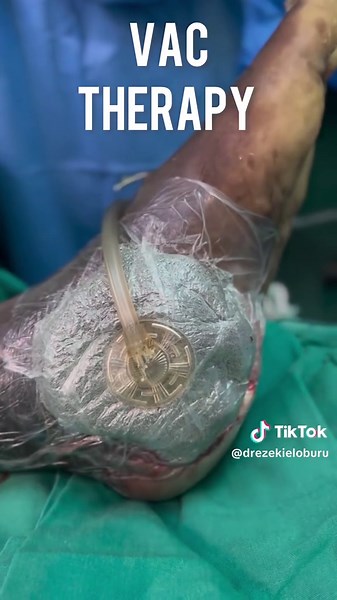 Vacuum Dressing for Faster Wound Healing