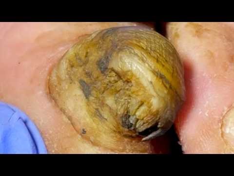 The Toenails Are Round And Fat, They Look Like They Are Wearing Hats, So I Cut Them Off!