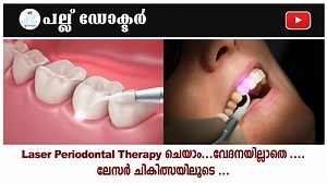 Laser Periodontal Therapy, also known as laser-assisted periodontal...
