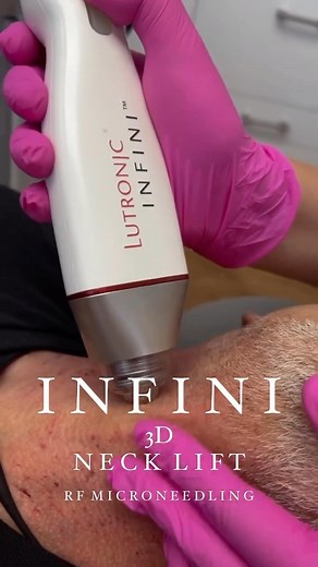 INFINI 3D NECK LIFTING Fall is the perfect season to start your #InfiniRF treatments! INFINI stimulates collagen growth and tissue tightening, improving the texture of the skin and the overall appearance of the face and neck. It is excellent for fine lines, wrinkles, skin laxity, large pores, acne, and scars The procedure usually takes 30 minutes to 1 hour. It comes with minimal downtime. We use topical numbing for enhanced comfort. The INFINI treatment can be used on all skin types and can also