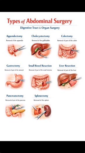 Body/Mind/Soul on Instagram: "Here are the different types of abdominal surgery categorized by function: Digestive Tract & Organ Surgery: Appendectomy: Removal of the appendix, usually to treat appendicitis. Cholecystectomy: Removal of the gallbladder for gallstones or inflammation. Colectomy: Removal of part or all of the colon to treat cancer or diverticulitis. Gastrectomy: Partial or total removal of the stomach. Small Bowel Resection: Removal of a portion of the small intestine. Liver Resect