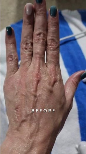 Hands Fascia Blaster Review - Before and After