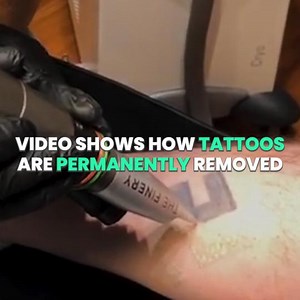316K views · 472 reactions | It's so weird seeing tattoos being permanently removed!  Removery | IGV | Facebook