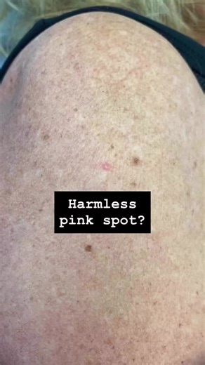 Dermoscopy: Understanding Skin Cancer Risks