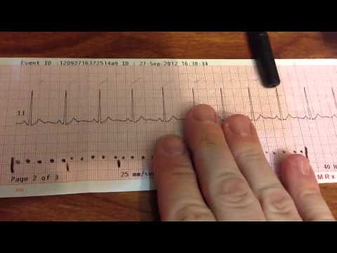 Looking at a normal 12 lead ECG