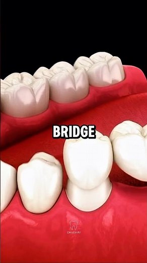 How a Dental Bridge Restores Your Smile 🦷✨ #dentist