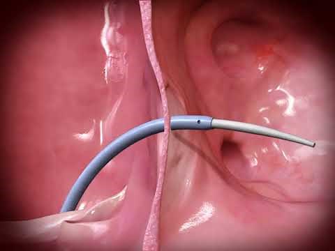 HeartSpan® Steerable Sheath Introducer
