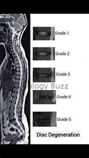 🧠🦴 MRI SPINE | DISC DEGENERATION (GRADES 1–5) 🦴🧠 Intervertebral disc degeneration is a common MRI finding, especially with aging and chronic mechanical stress. The image illustrates the graded spectrum of disc degeneration, helping radiology professionals correlate imaging features with clinical symptoms. 📌 Grading Overview (MRI – T2 weighted focus): 🔹 Grade 1: Normal disc height and high T2 signal (well-hydrated disc) 🔹 Grade 2: Mild loss of signal intensity, structure preserved 🔹 Grade