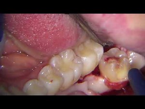 Lower third molar extraction with microscope