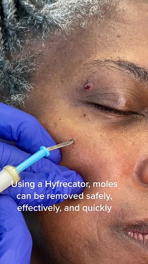 Safe, effective, and quick mole removal using a #hyfrecator ✨ #moleremoval #houstonmedspa
