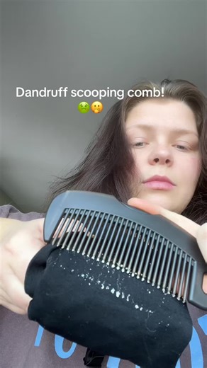Effective Dandruff Comb for a Clean Scalp