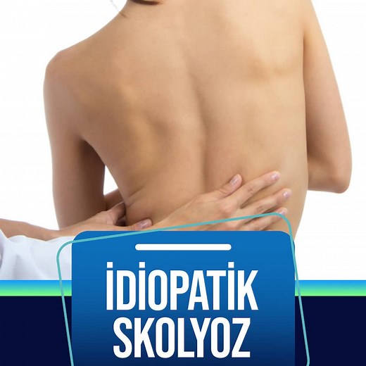 İdiopatik Skolyozun 5 Belirtisi, Tedavisi ve Ameliyatı 2026 Ankara