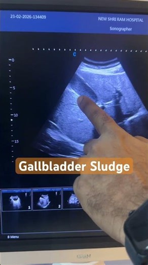 Gall Bladder Sludge #gallbladder #liver #ultrasound #abdomen #pain #shorts #yt #ytshort #trending