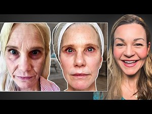 Cindy Spent $44k on Non-Surgical Treatments Before a Facelift: She Shares The Realities!