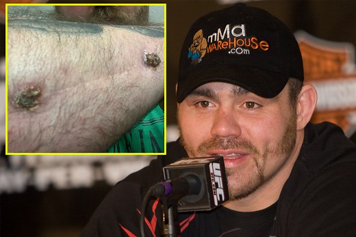 screw loose Ex-UFC heavyweight champion Tim Sylvia posts gruesome picture of infection in same arm broken by Frank Mir 16 years ago