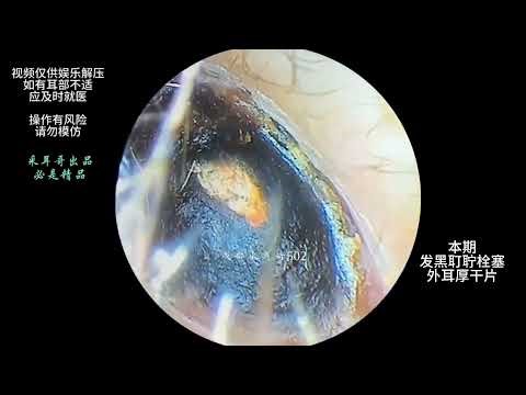 ASMR: Relaxing Ear Cleaning Asmr | Tingles & Sleep Sounds