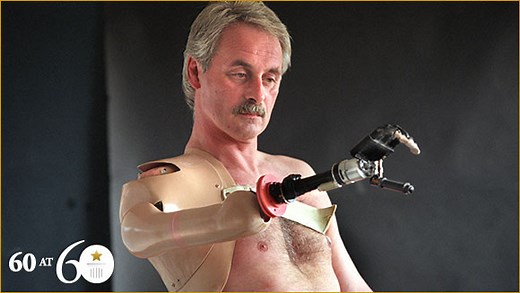 1993: First Bionic Arm