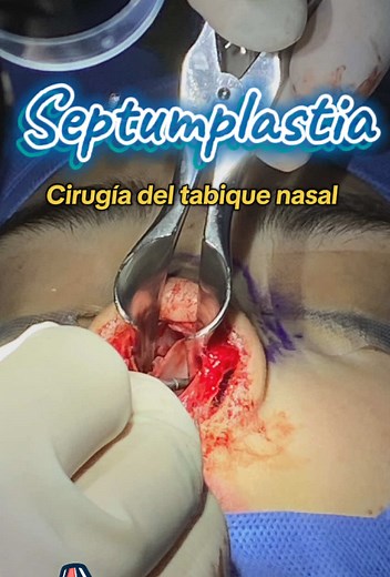¿Sabes en qué consiste una cirugía del tabique nasal? 😃 Si tienes du...