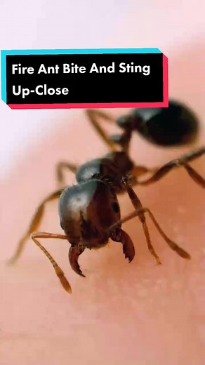 Fire Ant Bite and Sting Up-Close