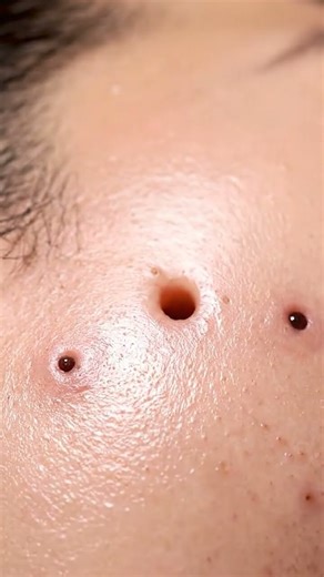 Most Satisfying Blackhead Vacuum Extraction Ever! Real Deep Pore Cleaning ASMR for Stress Relief,