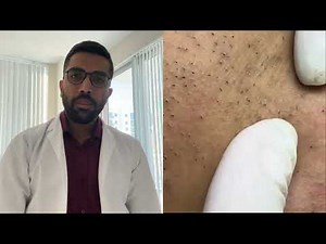 Multiple Extractions Explained by Derm