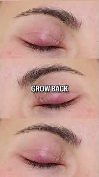 The Tiny Oil Glands in Your Eyelids
