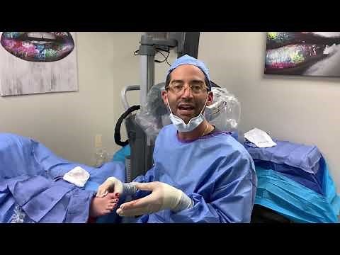 MINIMALLY INVASIVE FOOT SURGERY: CHEILECTOMY FOR GREAT TOE JOINT ARTHRITIS (Hallux Limitus) 💪💪💪