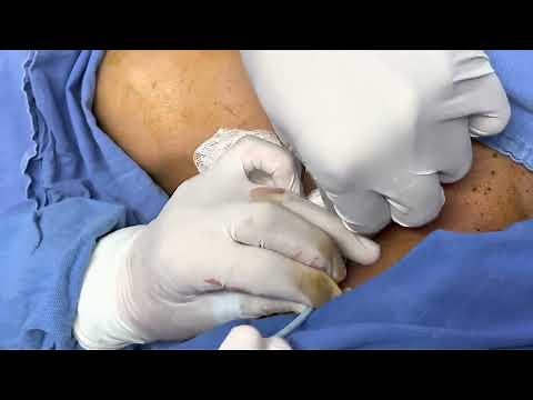 Colocación de catéter Mahurkar