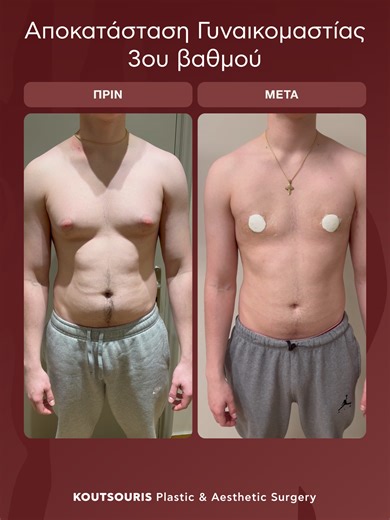 Αποκατάσταση Γυναικομαστίας Σταδίου 3 – Φυσικό αποτέλεσμα από τις πρώτες κιόλας μέρες! Σε αυτό το περιστατικό διορθώσαμε οριστικά την προβολή αδένων & λιπώδους ιστού με: ✔ VASER ✔ Παλμική & Κλασική Λιποαναρρόφηση ✔ Ενδοσκοπική αφαίρεση αδένων 📍 Ελάχιστες τομές 📍 Χωρίς μελανιές 📍 Άμεση αποθεραπεία – ο ασθενής επιστρέφει στην καθημερινότητά του άνετα Το αποτέλεσμα: καθαρός θώρακας, μόνιμο αποτέλεσμα & ακόμη καλύτερη εικόνα παράλληλα με γυμναστική. 📩 Στείλε μας τις ερωτήσεις σας σε προσωπικό μή