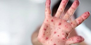 Suspected measles cases reported in Jackson County