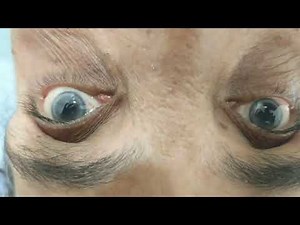 Supine Roll Test (Right Short Anterior Ampullary Arm Horizontal Semicircular Canalolithiasis)