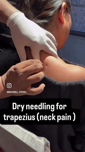 Dry needling for trapezius n(neck pain ) #foot #physiohub #doctor #motivation #physiotherapist.