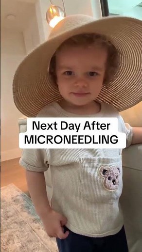 WHAT SHOULD I DO AFTER MICRONEEDLING
