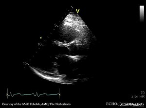 File:Amplatzer device E00187 (CardioNetworks ECHOpedia).webm - Wikimedia Commons