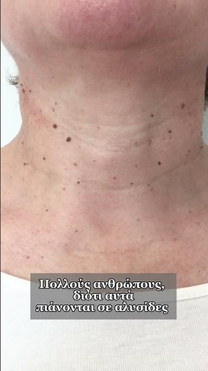 Θηλώματα στον Λαιμό - Θεραπεία #skintags #skintagsremoval #θηλωματα