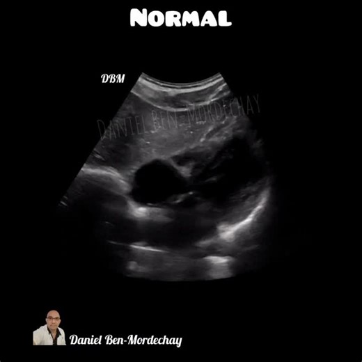 Mastering the subxiphoid view in ultrasound for pericardial effusion diagnosis. | Daniel Ben-Mordechay posted on the topic | LinkedIn