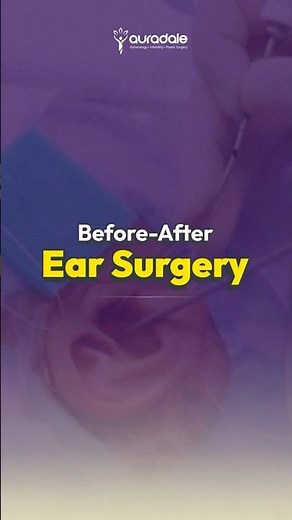 Before and After: Ear Reshaping #Otoplasty #Transformation