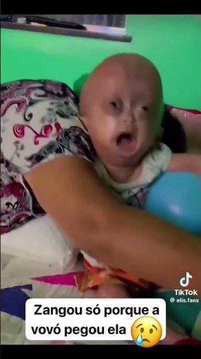 Elis afraid of grandma #progeria #baby #twins #elisyeloa #God bless