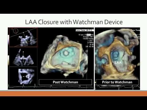Echocardiography Fluoroscopy Fusion Imaging - Watchman Procedure & Mitral Paravalvular Leak Closure