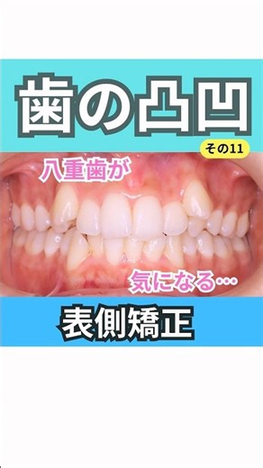 歯の凸凹を治す矯正症例動画です。上下左右4番抜歯、アンカースクリュー併用、上下表側矯正です。# #矯正歯科 #矯正症例 #叢生#アンカースクリュー#crowdedteeth