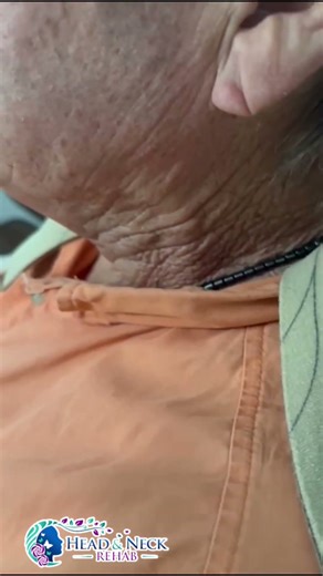 Radiation fibrosis, neck spasms, and swallowing difficulty