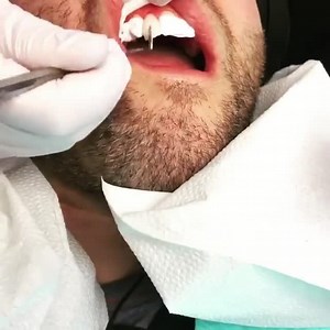 Dental Bonding Procedure