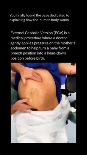 The Human Body 🧬 on Instagram: "Follow @explainingthebody to learn everything about technology one post at a time 🧠⚙️ External Cephalic Version (ECV) is a specialized medical procedure used to manually turn a fetus from a breech or transverse position into a head-down (vertex) position before labor begins. When a baby is breech, their buttocks or feet are positioned to emerge first, which significantly increases the risk of complications during a vaginal delivery. The procedure involves an obs