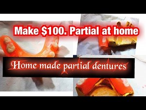 Acrylic Partial Denture how is made For just $100 budget
